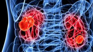 rinichi_poza_buna_si_frumoasa_11002200