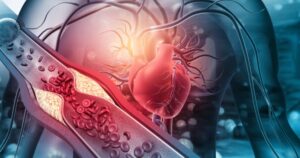 Colesterolul redus într-o săptămână. Cinci pași recomandați de nutriționiști