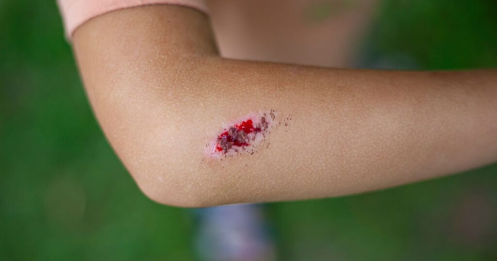 Boala infecțioasă gravă, cu mortalitate ridicată dacă nu este tratată rapid și corect. Sporii care o cauzează pot supraviețui ani de zile