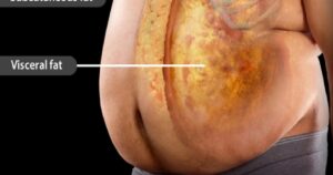 Cum atacă grăsimea viscerală „ascunsă” organele interne: videoclipul viral care șochează internetul. Pericol și pentru persoanele slabe