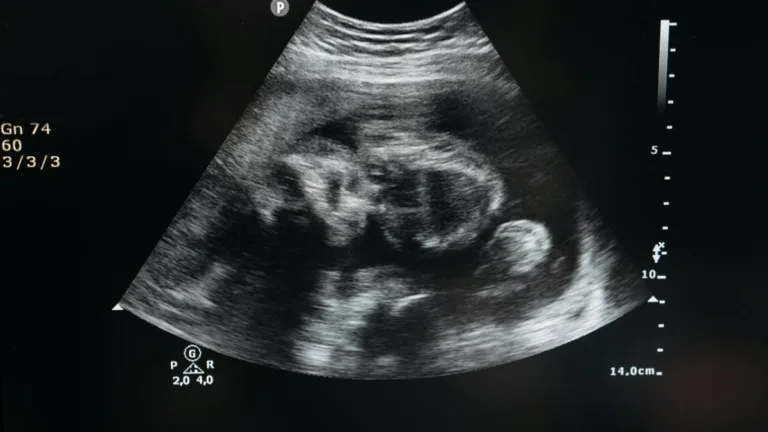 Ce este un lithopedion sau „bebelușul de piatră”? O raritate medicală care fascinează lumea