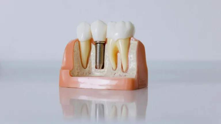 Câte implanturi dentare se pot face odată? Dr. Nicolae Krilovici, răspuns