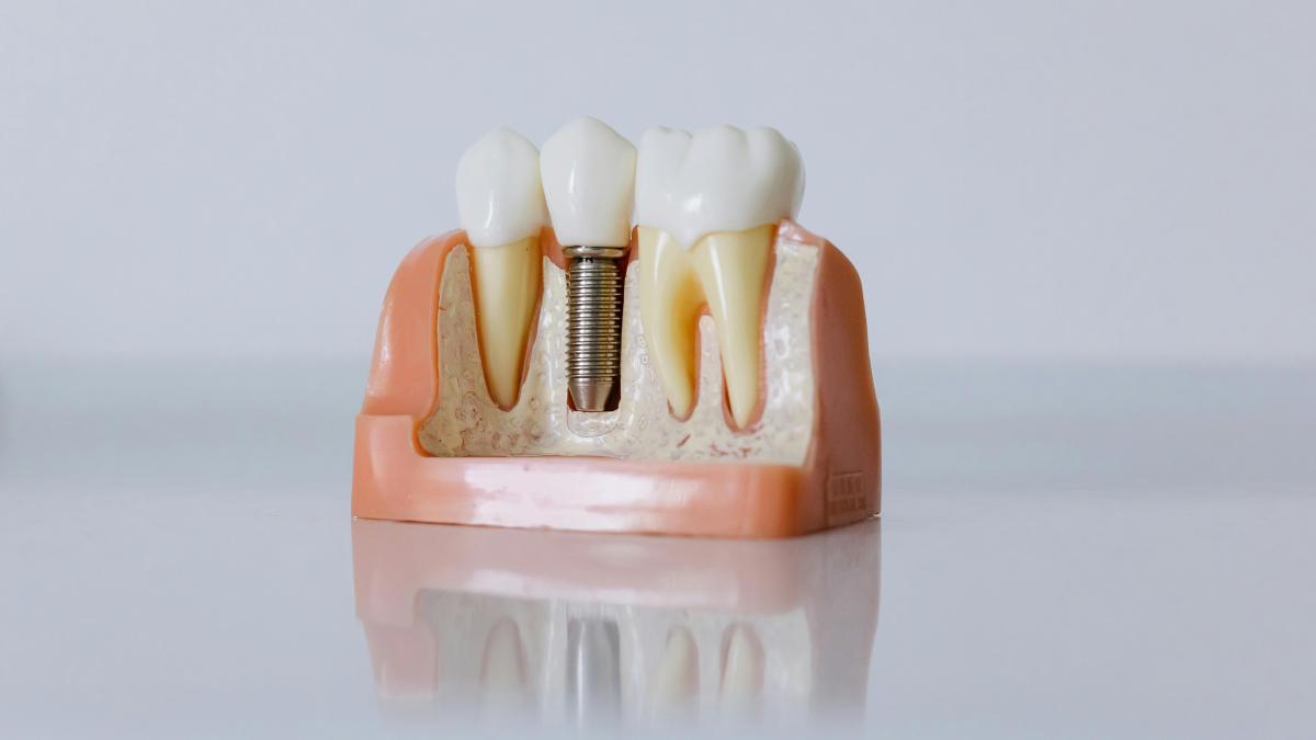 Câte implanturi dentare se pot face odată? Dr. Nicolae Krilovici, răspuns