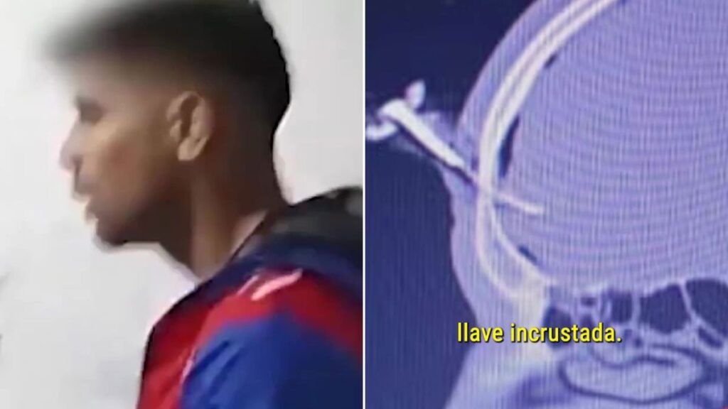 Operat pentru a-i fi extrasă o cheie de mașină înfiptă în cap! Imagini șocante