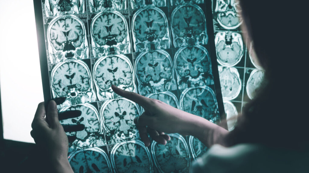 Boala Alzheimer ar putea fi reversibilă, contrazicând o teorie veche de un secol. Ce au descoperit cercetătorii