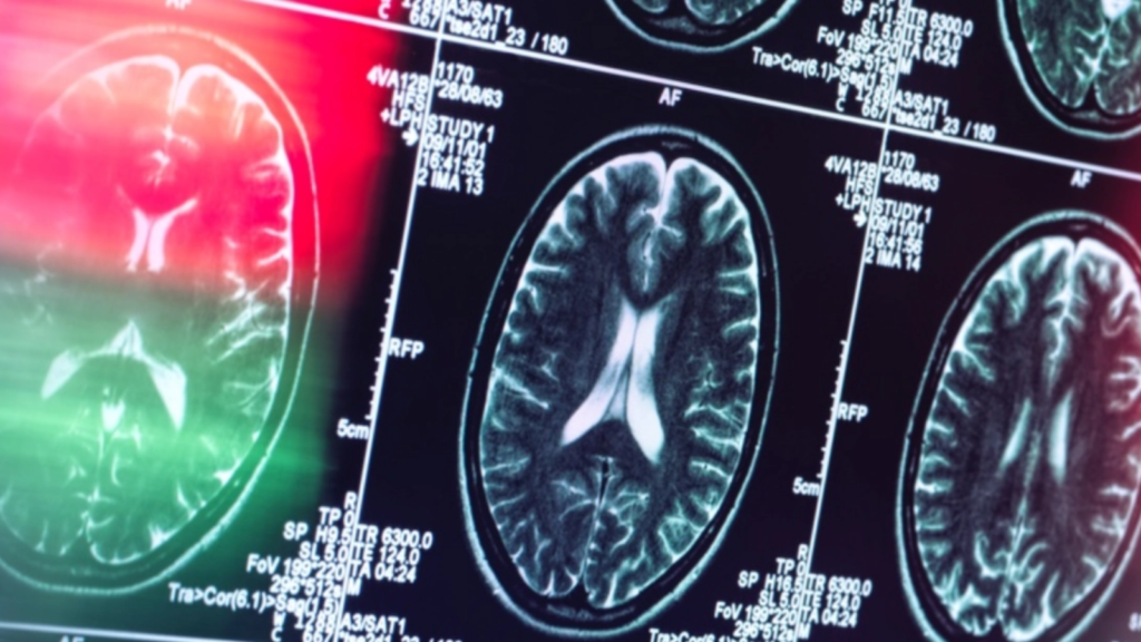 Institutul de Psihiatrie ‘Socola’ introduce un tratament unic în România pentru Alzheimer